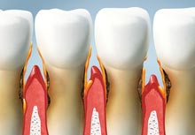 parodontitis2-praxis-zahnarzt-pirmasens