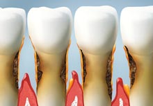 parodontitis3-praxis-zahnarzt-pirmasens